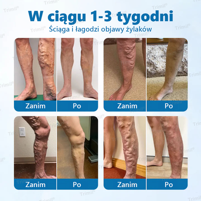 Trimil® Ziołowy Spray na Ochronę Żył – Klinicznie udowodniono, że eliminuje żylaki w zaledwie 7 dni!