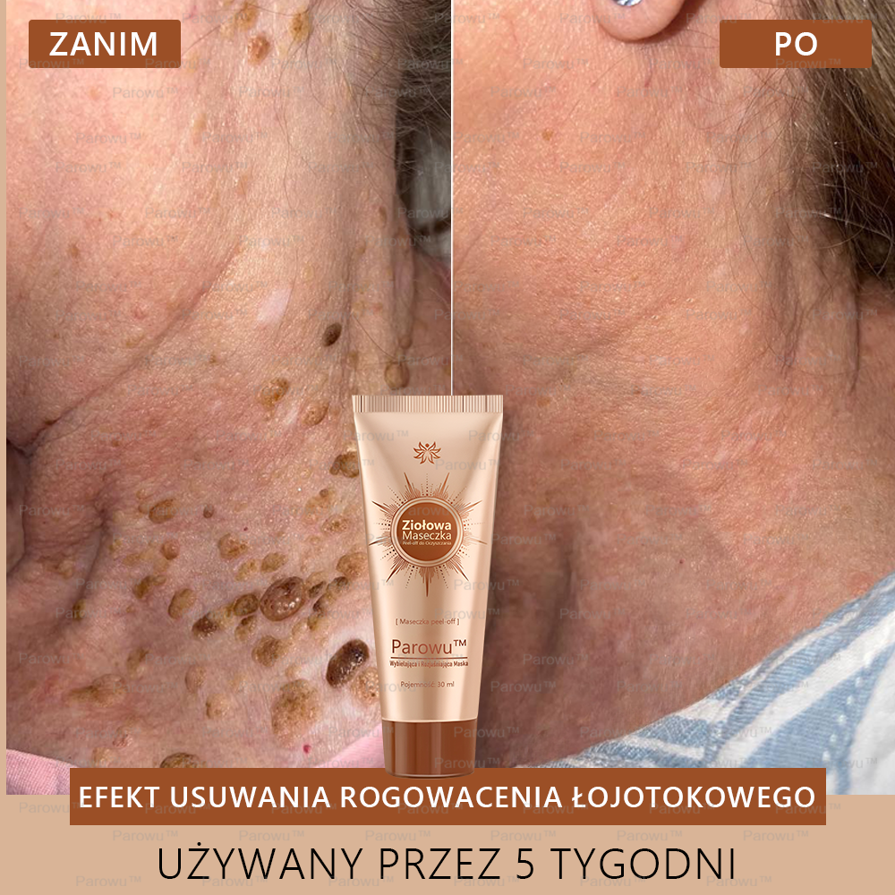 Parowu™ Wybielająca i Rozjaśniająca Maska ✨ Naturalne składniki trwale usuwają plamy, piegi i przebarwienia